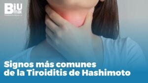 Tiroiditis de Hashimoto